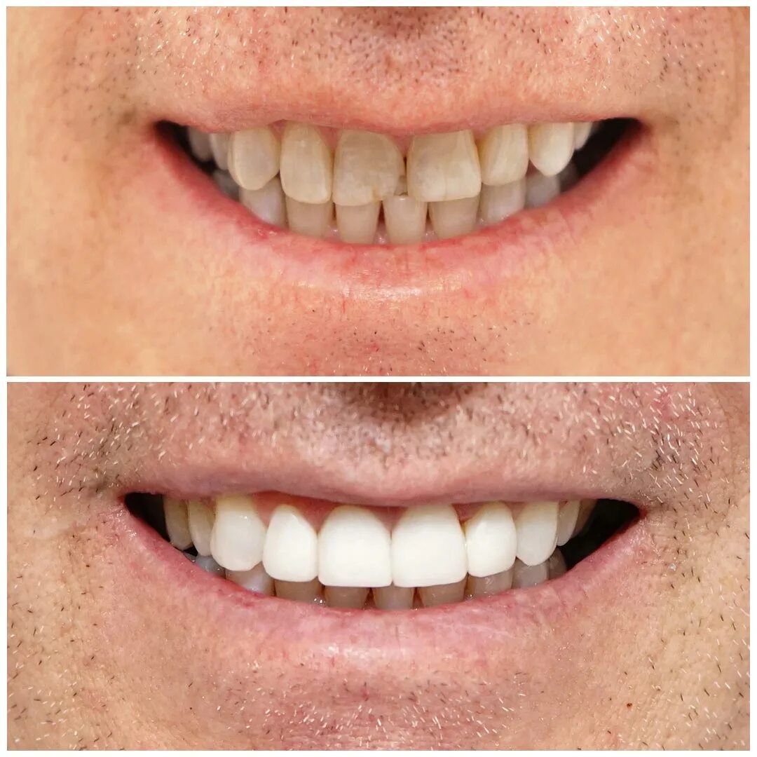experts at dental veneers The Perfect Smile Studios 01992 552115