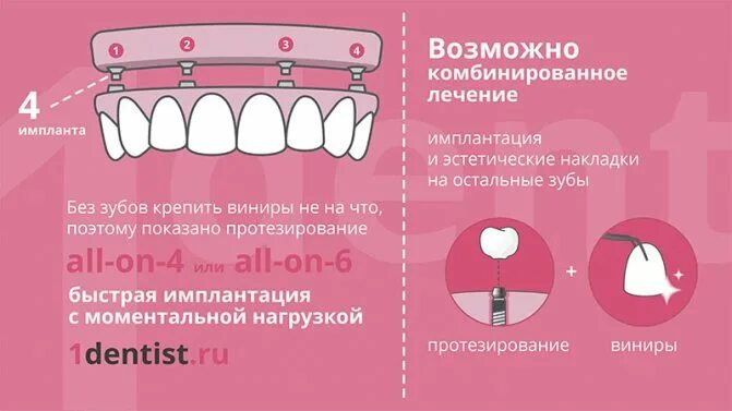 Что можно поставить вместо импланта. Двухэтапная имплантация зубов этапы. двухэтапный протокол имплантации. протоколы имплантации зубов. схема установки импланта.