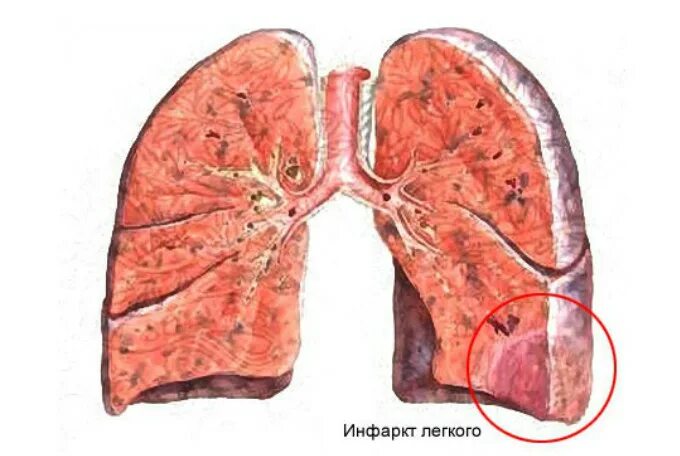 Легкие после инфаркта