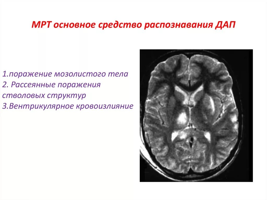 Диффузное поражение мозга. Диффузное аксональное повреждение головного мозга кт. Поражение мозолистого тела. Симптомы поражения мозолистого тела. Синдром поражения мозолистого тела.