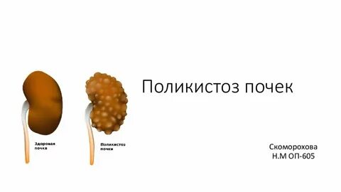 Поликистоз печени мкб 10