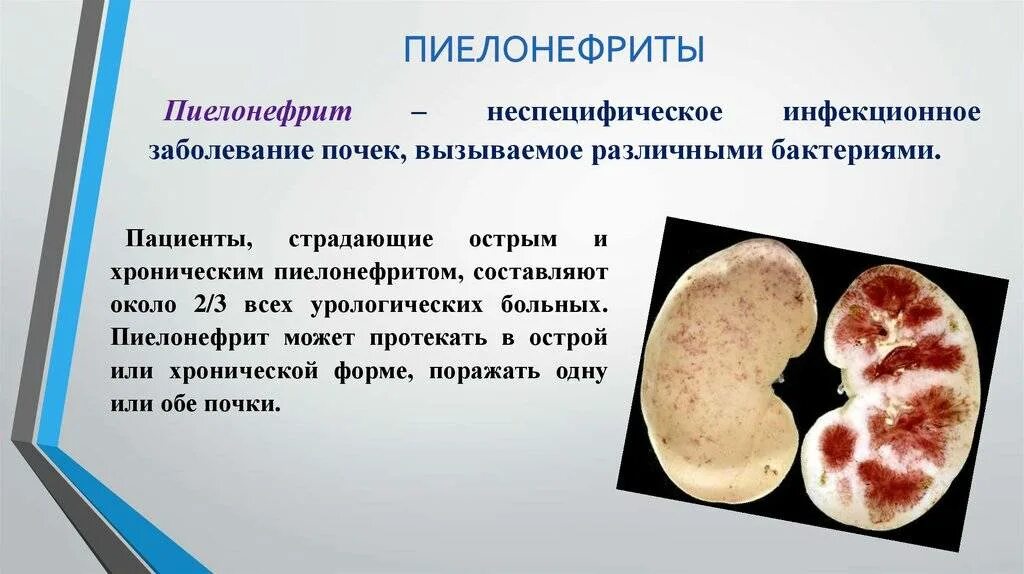 Пиелонефрит и гломерулонефрит почка. Острый нефрит пиелонефрит. ГНОЙНИЧКОВЫЙ пиелонефрит. Почка при хроническом пиелонефрите.