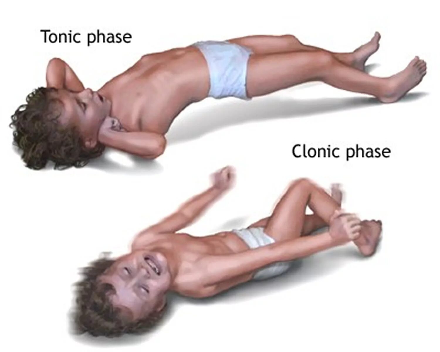 Тонические судороги столбняк. Тонические судороги у детей и клонические судороги. Эпилепсия судорожный синдром у ребенка. Клонические судороги клиника.