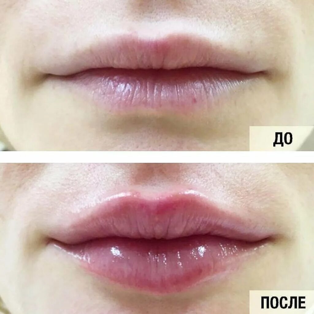 2 мл гиалуроновой кислоты. Коррекция губ гиалуроновой кислотой 1 мл. 0 5 мл гиалуроновой кислоты в губы. 1мл гиалуронка в губы 1 мл гиалуронка.