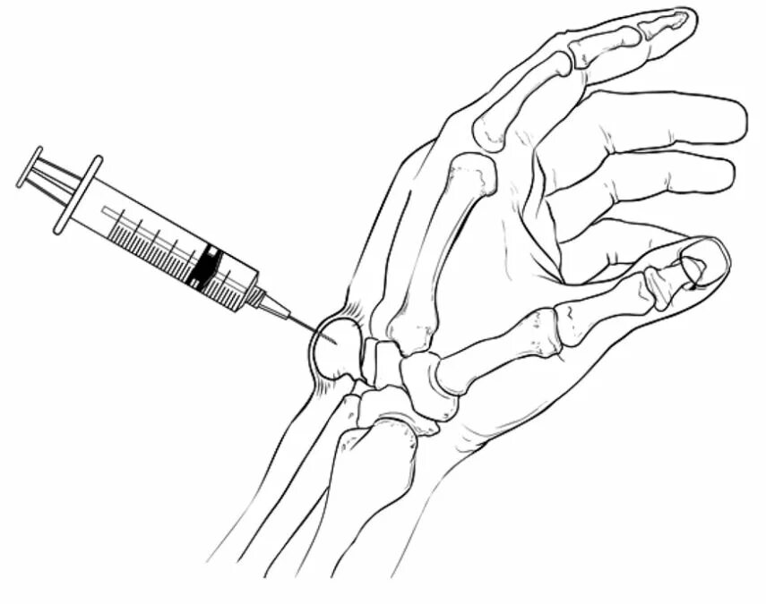 Пункция лучезапястного сустава. Сухожильный ганглий лучезапястного сустава. Гигрома (ганглий) лучезапястного сустава.