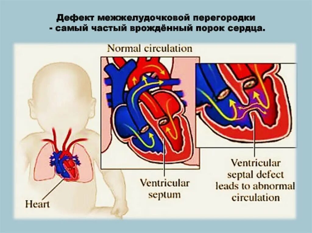 Впс дмжп у детей. Врожденные пороки сердца дефект межжелудочковой перегородки(дмжп). перимембранозный дефект межжелудочковой перегородки. гемодинамика новорожденного при дмжп.