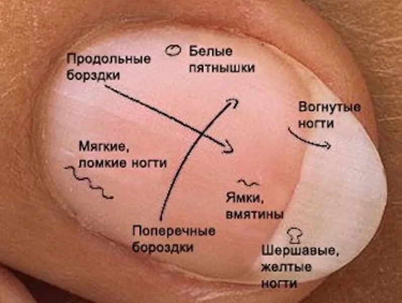 Определить заболевание по рукам. Диагностика по ногтям. Состояние здоровья по ногтям.