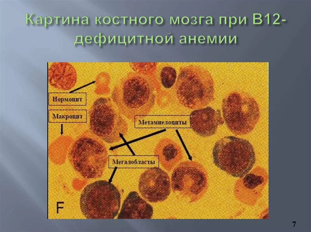 Картина костного мозга при в12 дефицитной анемии. Изменения костного мозга при б12 дефицитной анемии. Костный мозг при в12 дефицитной анемии. Изменения в костном мозге при в12 дефицитной анемии.