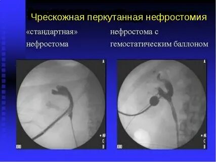 Нефростомия