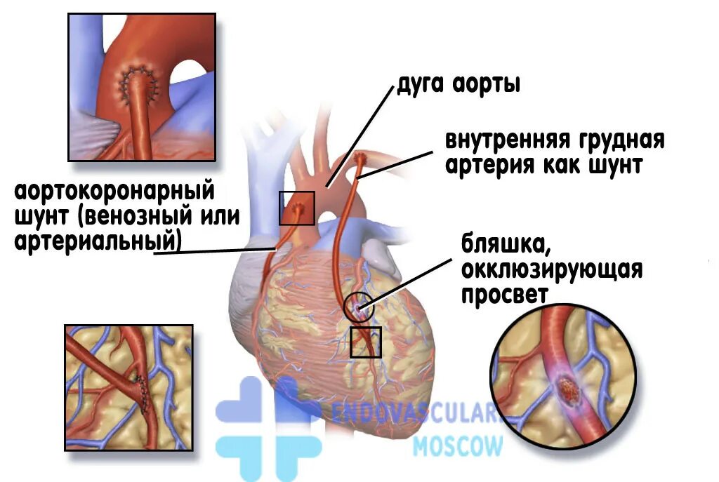 Шунт в медицине. Операция шунтирование сосудов сердца. Шунтокоронарное шунтирование. Коронарное шунтирование сосудов.