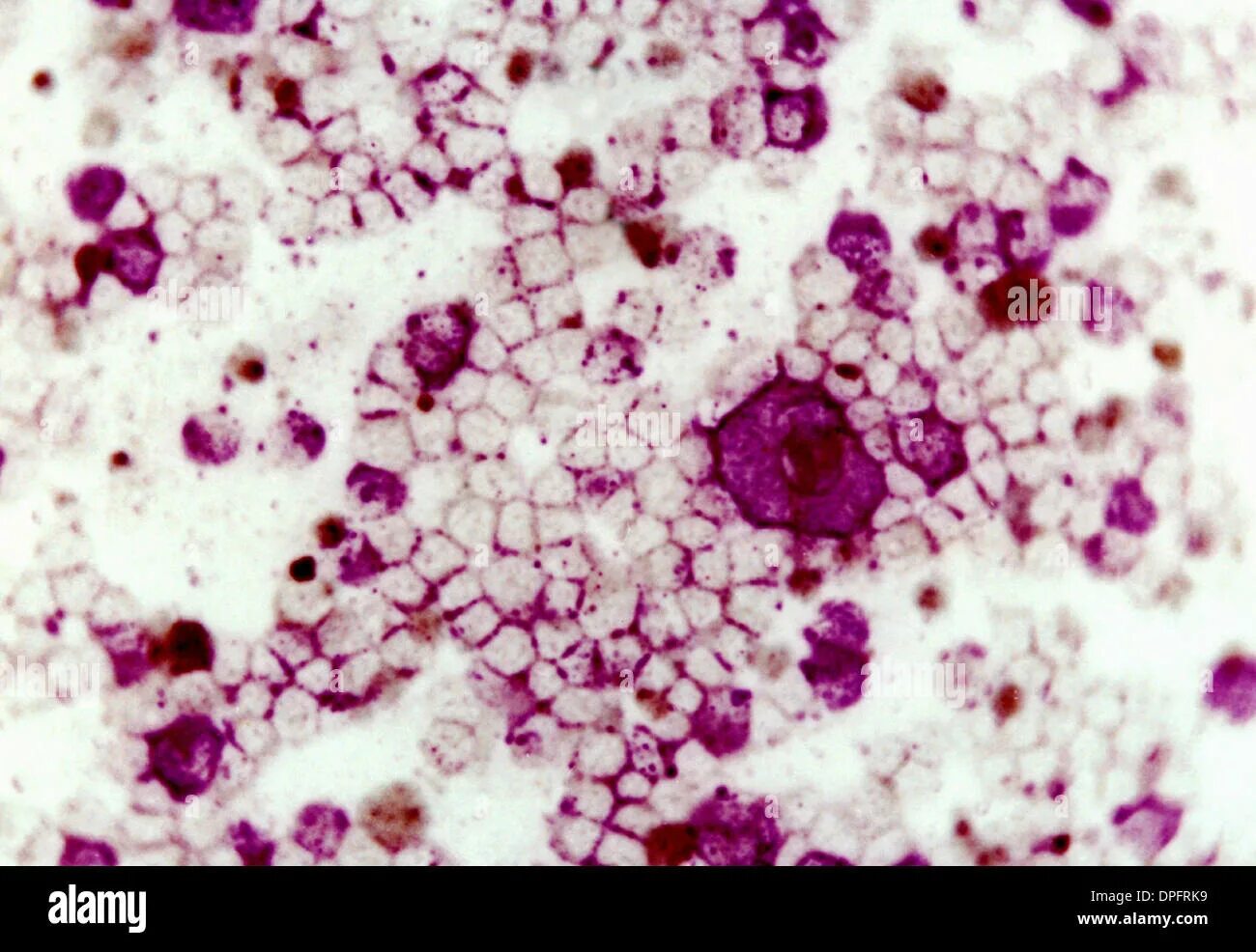 Syncytial virus. Синцитиальный вирус микробиология. Респираторно- синцитиальный вирус резистентность. Респираторно синцитиальный вирус патанатомия. Респираторно-синцитиальный вирус фото.