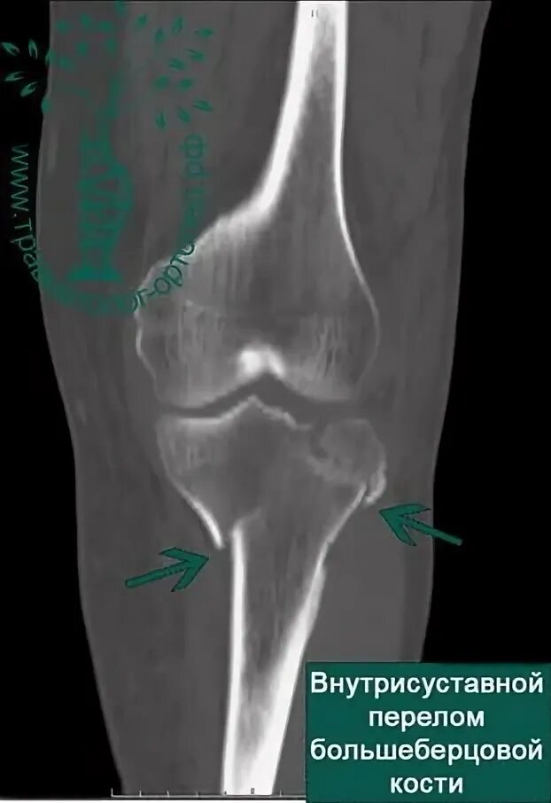 Перелом в колене большеберцовой кости. Импрессионный перелом сустава. Импрессионный перелом мыщелка коленного сустава. Перелом мыщелка берцовой кости коленного сустава.