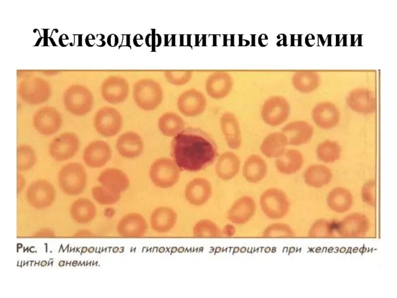 Гипохромия железодефицитная анемия. Гипохромия и микроцитоз эритроцитов. Анемия гипохромия микроцитоз. Гипохромия при железодефицитной анемии. Микроцитарные гипохромные эритроциты.