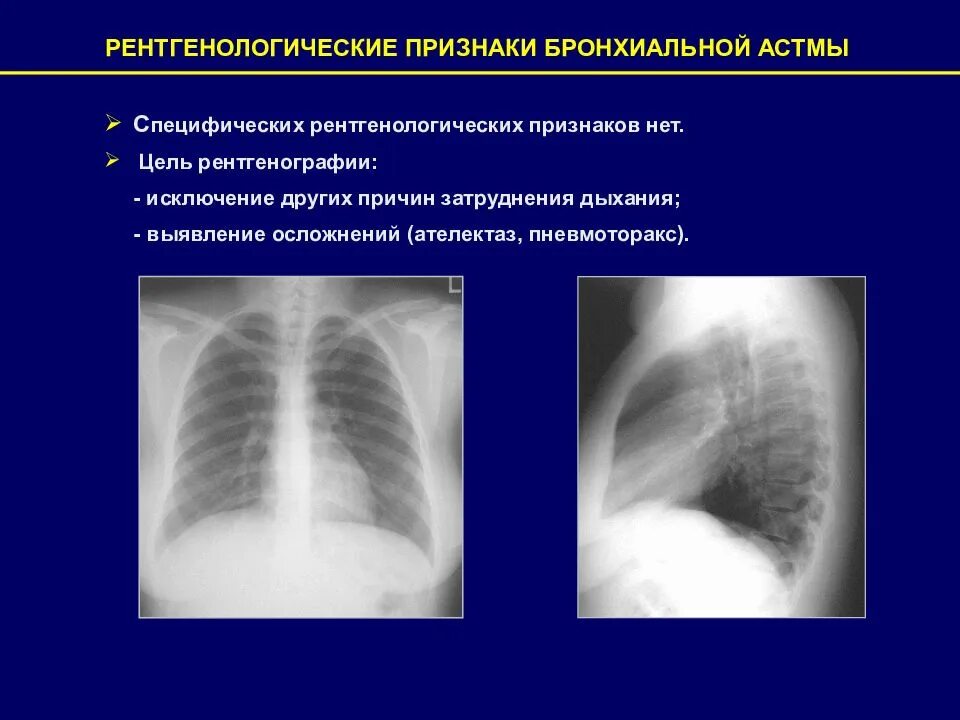 Рентгенологические признаки ателектаза. Рентгенологические признаки ателектаза. Компрессионный ателектаз легкого рентген. Ателектаз средней доли правого легкого рентген. Дисковидный ателектаз легкого кт.