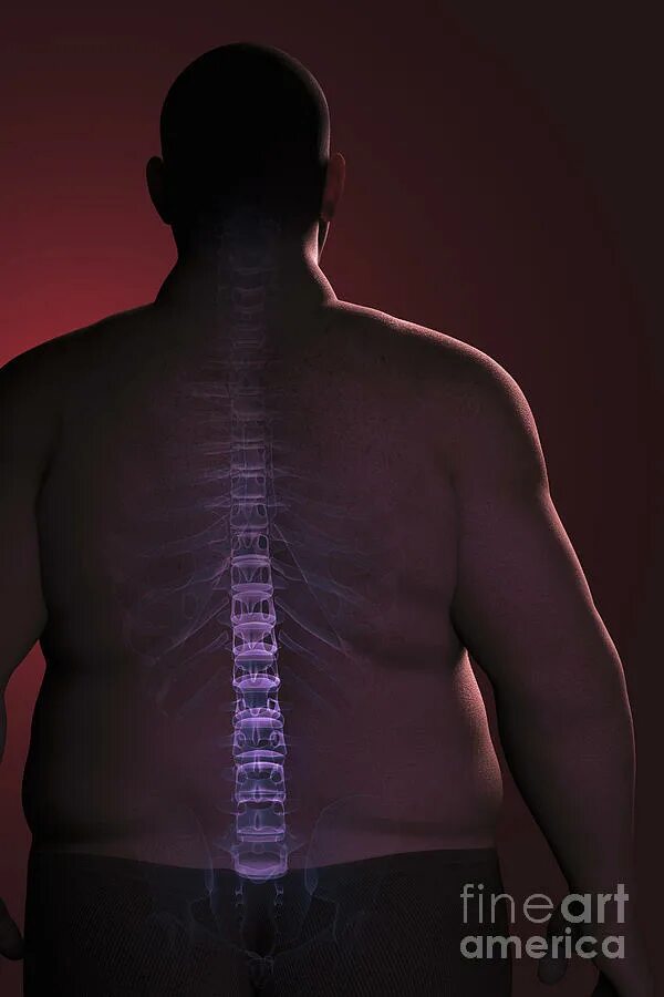 ожирение спины