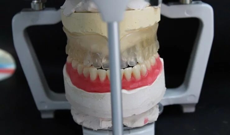 Несъемные зубные протезы. Окончательное моделирование полного съемного протеза. Несъемный протез цельнолитой. Современные методы протезирования зубов. Методы изготовления протезов