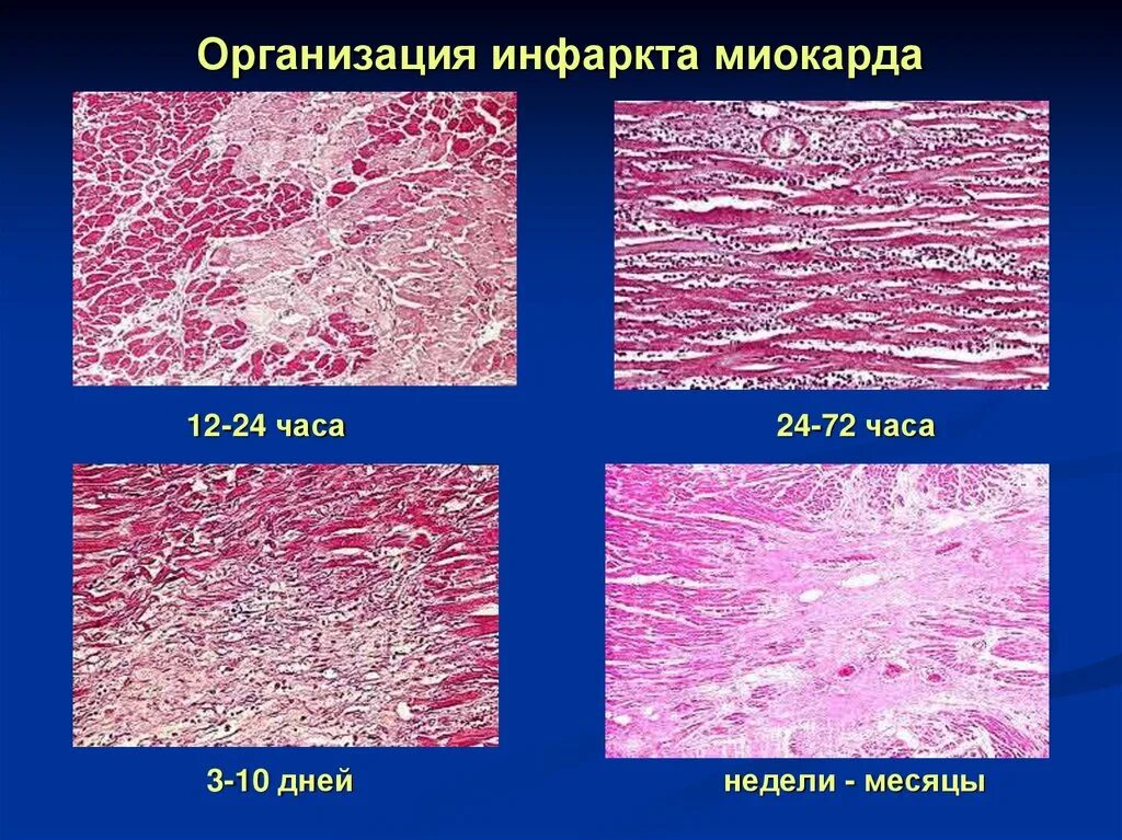 Инфаркт миокарда патанатомия. Острый инфаркт миокарда гистология. Патоморфология острого инфаркта миокарда. Тромб микропрепарат