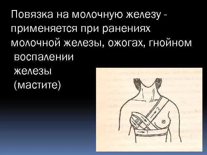 Поддерживающая повязка на молочную железу. Поддерживающая косыночная повязка на молочную железу. косыночная повязка на молочную железу алгоритм. наложите бинтовую повязку на молочную железу.. повязка на молочную железу техника наложения.