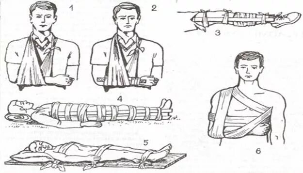Д3 при переломах. Транспортная иммобилизация способы иммобилизации. Средства транспортной иммобилизации средства иммобилизации. Транспортная иммобилизация конечностей. Транспортная иммобилизация хирургия.