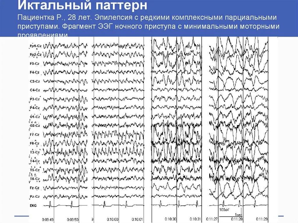 Ээг норма расшифровка. Эпилептические паттерны на ЭЭГ. Альфа ритм ЭЭГ при эпилепсии. Расшифровка показателей электроэнцефалограммы ЭЭГ головного мозга. ЭЭГ при эпилепсии расшифровка.