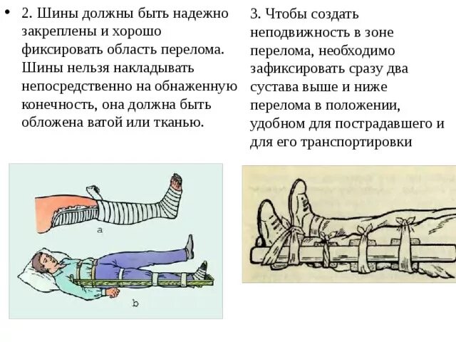 Перелом голени транспортировка. Наложение шины Крамера на голень алгоритм. Шина Крамера при переломе нижней конечности. Техника наложения транспортной шины Крамера на нижнюю конечность. Транспортная иммобилизация при переломе голени.