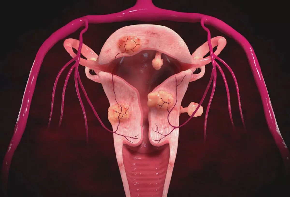Образование женских половых органов. Интрамуральная лейомиома матки. Пролиферирующая миома.