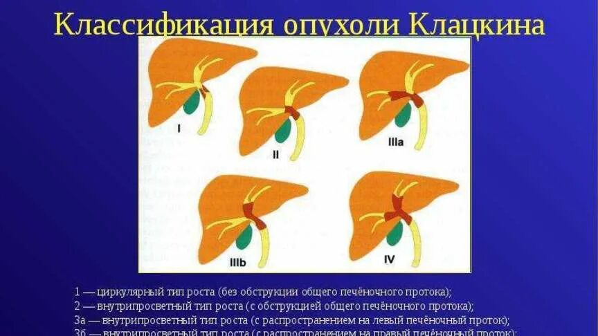 Холангиокарцинома печени патологическая анатомия. Tnm зно желчных протоков. Экономические факторы формирования спроса. Опухоль клацкина классификация. Холангиокарцинома печени патологическая анатомия.