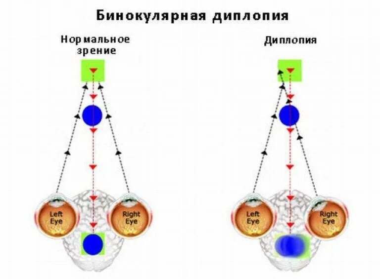 Диплопия монокулярная и бинокулярная. Бинокулярное зрение человека схема. Бинокулярное зрение это диплопия. Механизм бинокулярного зрения.