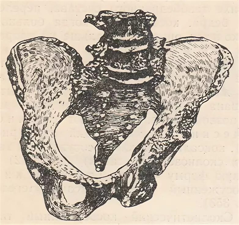 Тазовая кость вид сверху. Длинный таз. Кососмещенный таз. Плоский таз. Признаки беременности горвица гегара.