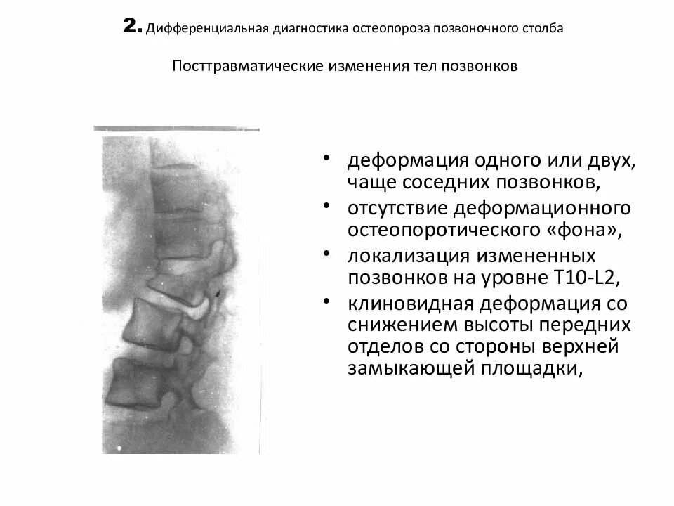 Компрессионный перелом позвоночника 1 степени рентген. Компрессионный перелом l1 позвонка рентген. Компрессионный перелом 1 поясничного позвонка рентген. Компрессионный перелом тела l3 позвонка 3 степени..