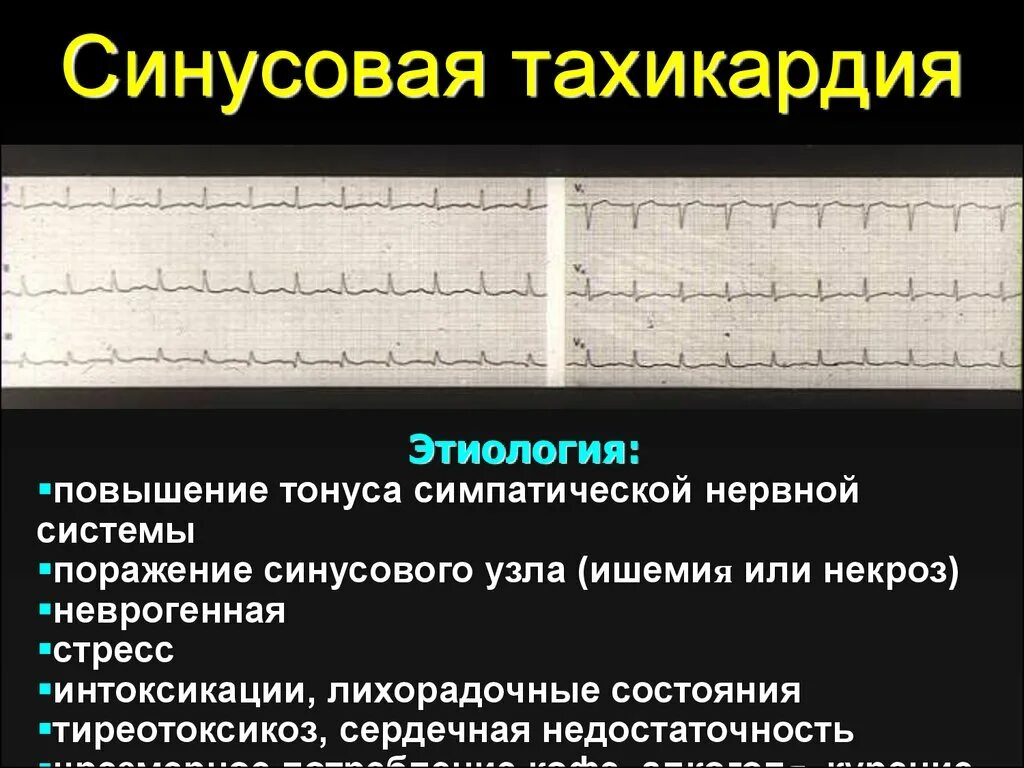 Синусовая тахикардия вертикальное. Синусовая тахикардия ЧСС 100 ЭКГ. Синусойдня тахикардия. Синусовая тахикардия на ЭКГ. При синусовой тахикардии :.