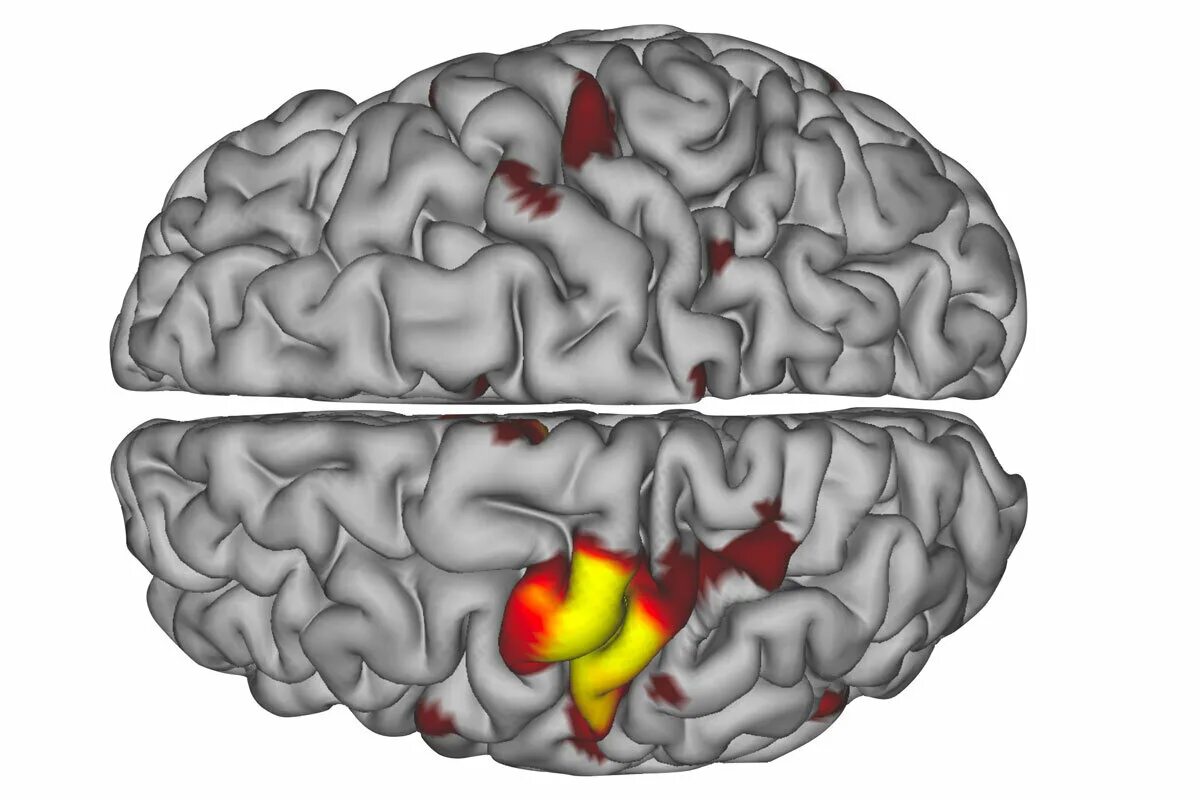 After brain. Пульс мозга. Neuroplasticity of the Brain. Brain Watershed areas MRI. Neurobiology of Mental illness.