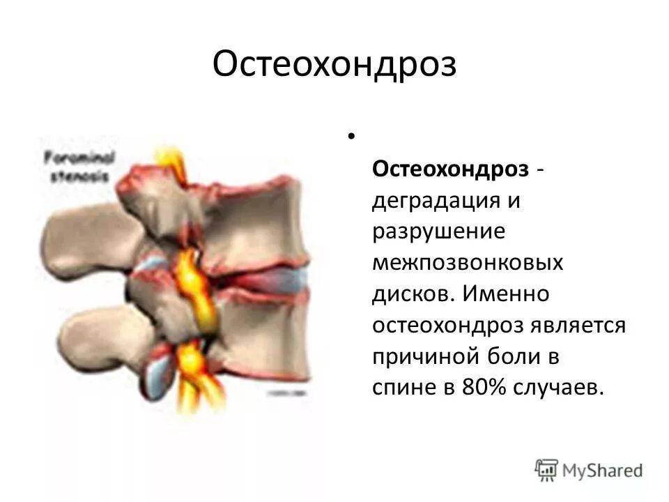 Фасеточный синдром поясничного отдела. Спондилоартроз дугоотросчатых суставов. Дугоотросчатые суставы позвоночника что это. Дугоотростчатые суставы поясничного отдела. Фасеточный сустав грудного отдела.