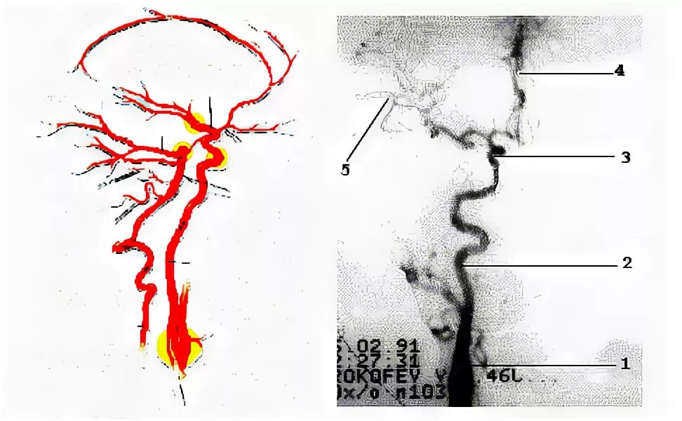 Интракраниальные артерии головного мозга. Каротидный бассейн головного мозга это. Каротидный и вертебробазилярный бассейн. Артерии каротидного бассейна. Интракраниальные сосуды.