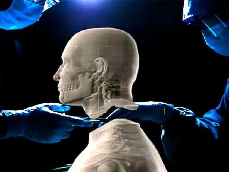 Первая в мире операция. Серджио Канаверо голова человека. Итальянский нейрохирург Серджио Канаверо. Трансплантация головы.