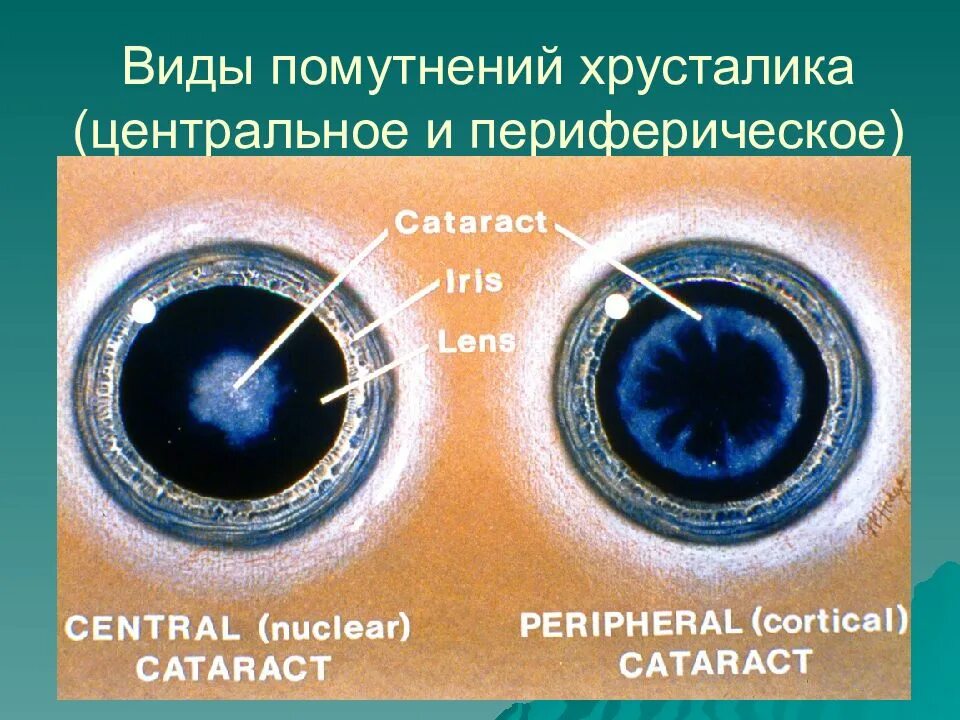 Зрачок и хрусталик. Функции зрачка и хрусталика. Строение зрачка. Какими опытами можно обнаружить функции зрачка