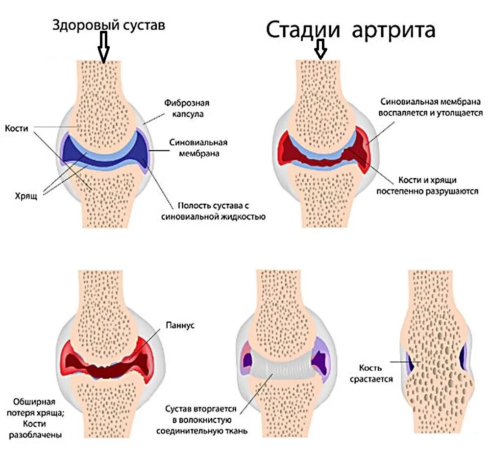 Артрит сустава что делать. Ревматоидный артрит голеностопного. Ревматоидный артрит голеностопа. Ревматоидный артрит схема. Ревматоидный артрит на щиколотке.