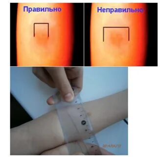 Что значит манту у ребенка