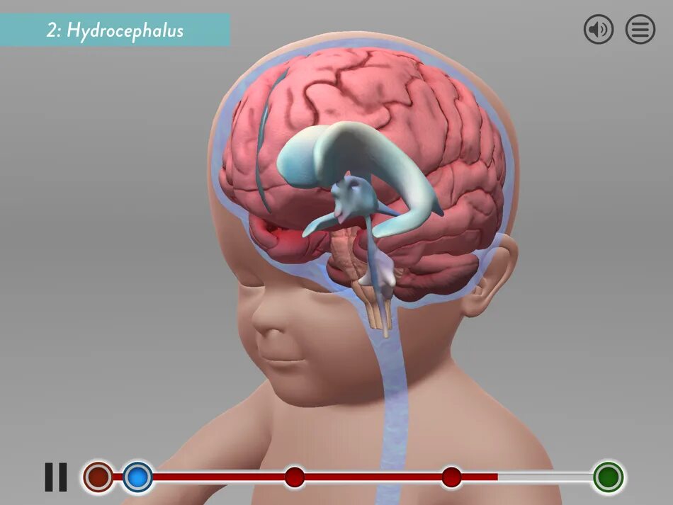 Мозг ребенка видео. Гидроцефалия головного мозга. Внутричерепное давление.