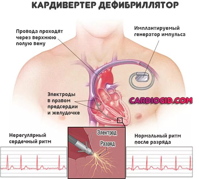 Сколько живут с кардиостимулятором. Имплантация кардиовертера-дефибриллятора. Имплантируемый кардиовертер-дефибриллятор. Имплантируемый кардиовертер-дефибриллятор (ИКД). Имплантация дефибриллятора.