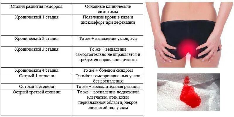 Почему геморрой при месячных. Геморрой симптомы у женщин. признаки геморроя симптомы.