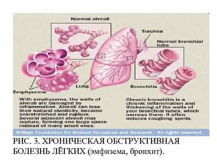 Эмфизема хронического бронхита. Хроническая обструктивная эмфизема легких. Хронический обструктивный бронхит реабилитация.