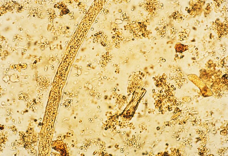 В копрограмме непереваренные. Копрология кала микроскопия. Клетчатка непереваримая микроскопия. Микроскопия кала копрограмма. Микроскопия кала соединительная ткань.