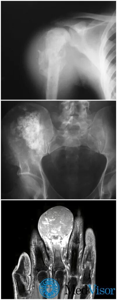 Рак в костях прогноз. Хондросаркома кости 4 стадия. Хондросаркома рентген.