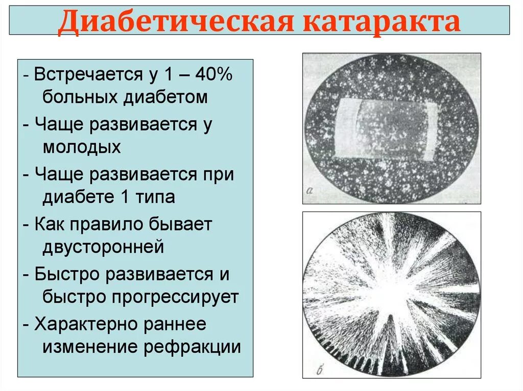 Катаракта при сахарном диабете. Катаракта при сахарном Диаб.