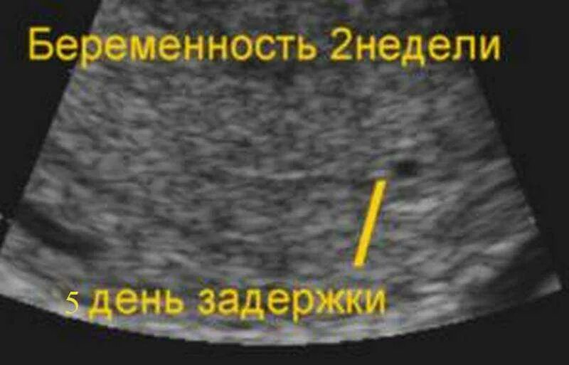 Как выглядит 1 неделя беременности. Узи беременности на ранних сроках. маточная беременность на узи на раннем сроке. узи на беременность 1 день задержки.
