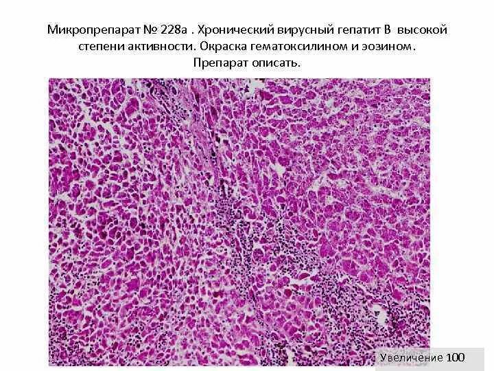 Печень микропрепарат описание. Мультилобулярный цирроз печени микропрепарат. Хронический активный вирусный гепатит микропрепарат. Постнекротический цирроз печени микропрепарат. Портальный цирроз печени гистология.