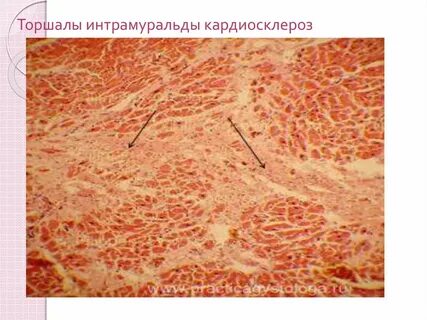 Атеросклеротический кардиосклероз