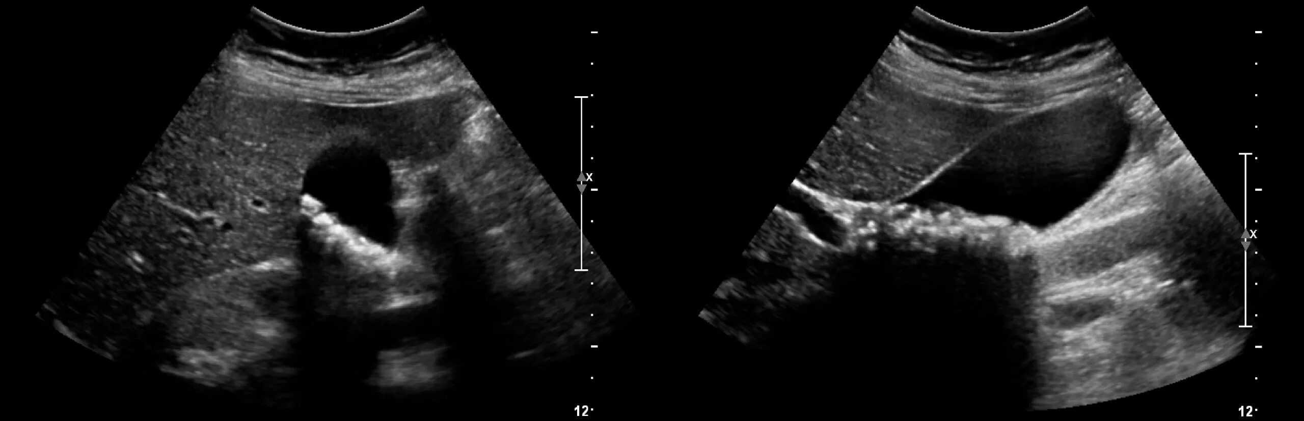Узи жкб. Гиперэхогенный желчный пузырь УЗИ. Конкременты желчного пузыря что это такое. Конкременты желчного пузыря УЗИ.
