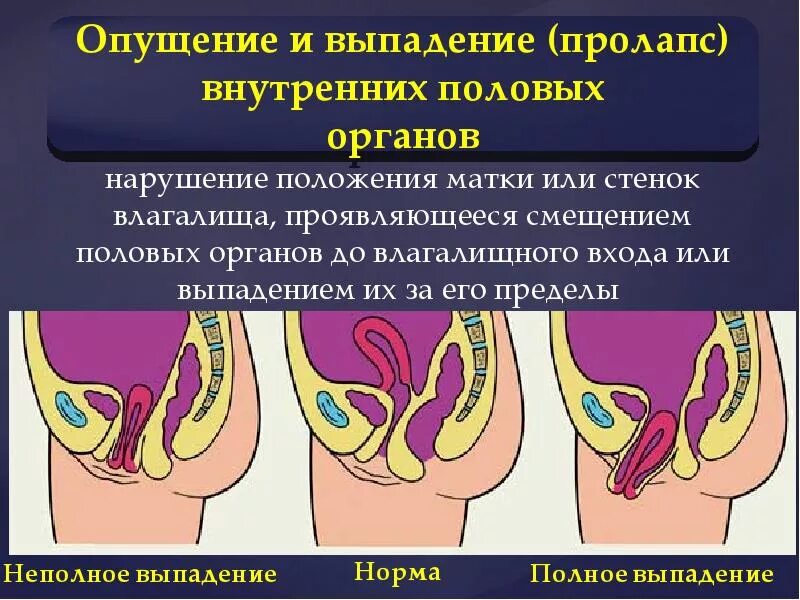 классификация пролапса. степени выпадения матки классификация. пролапс тазовых органов степени. гастроптоз 3 степени рентген. степени опущения почек.